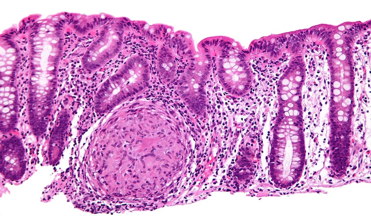 Crohn's_disease_-_colon_-_high_mag