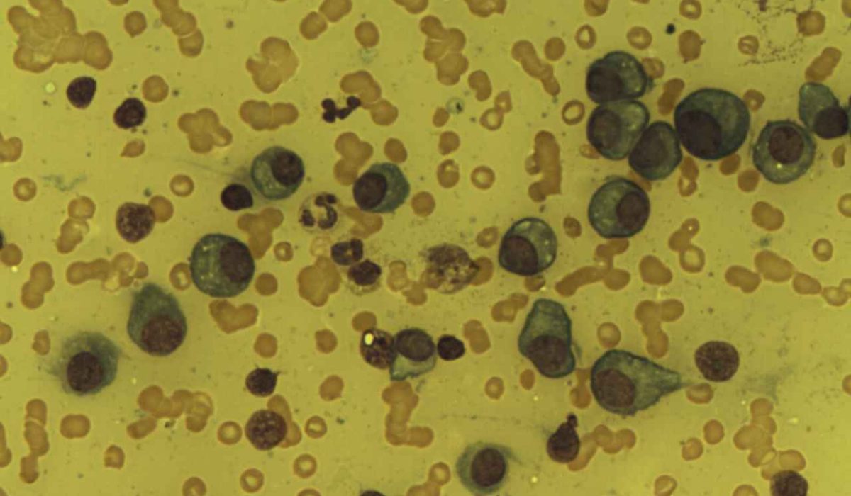 Plasma_Cells_in_Multiple_Myeloma_patient