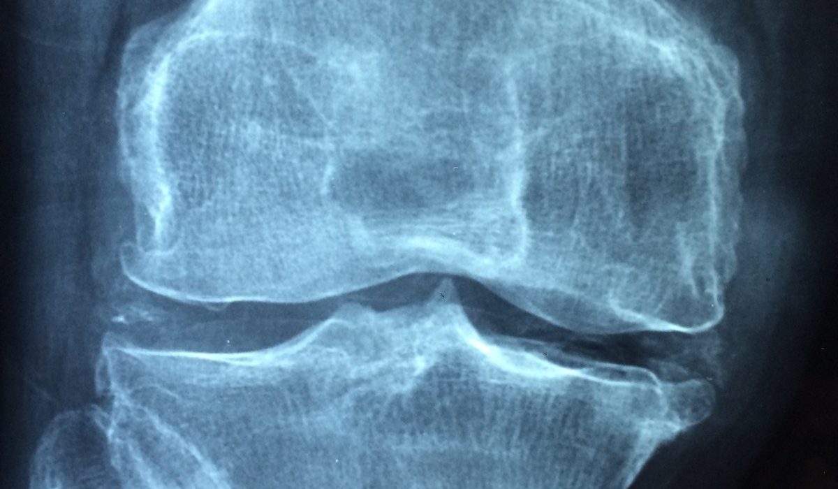 knee_old_care_injury_pain_knee_pain_inflammation_osteoarthritis-619689.jpg!d